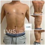 Liposuction Before & After Patient #682