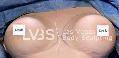 Breast Augmentation Before & After Patient #717