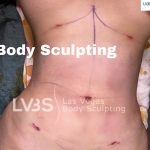 Liposuction Before & After Patient #685