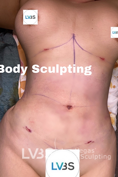 Liposuction Before & After Patient #685