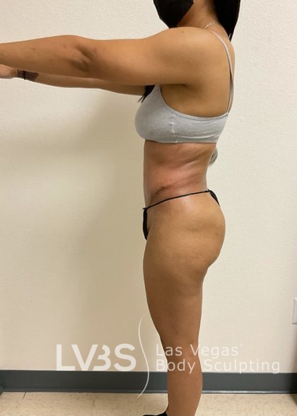 Liposuction Before & After Patient #688