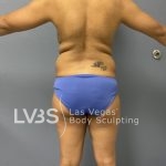 Liposuction Before & After Patient #688