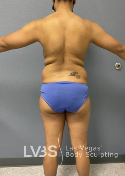 Liposuction Before & After Patient #688