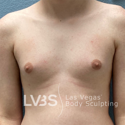 Gynecomastia Before & After Patient #668