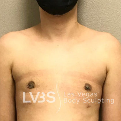 Gynecomastia Before & After Patient #668