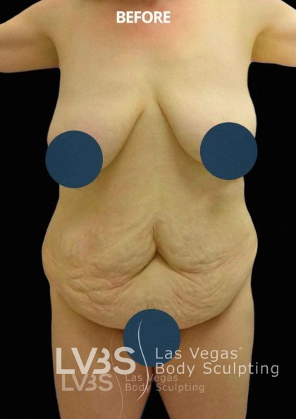 Corset Tummy Tuck Before & After Patient #741