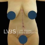 Corset Tummy Tuck Before & After Patient #741