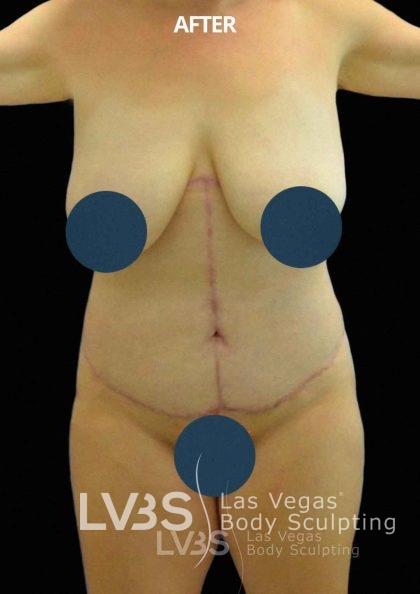 Corset Tummy Tuck Before & After Patient #741