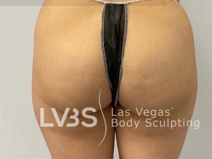 Brazilian Butt Lift (Fat Transfer to Butt) Before & After Patient #775