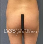 Liposuction Before & After Patient #787