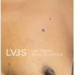 Breast Augmentation Before & After Patient #804