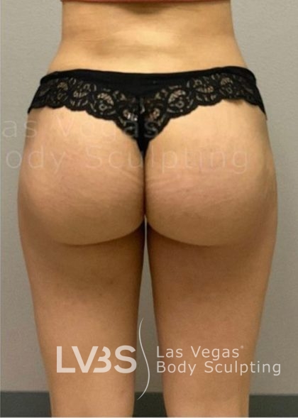 Liposuction Before & After Patient #787
