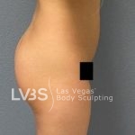 Liposuction Before & After Patient #787