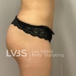 Liposuction Before & After Patient #787