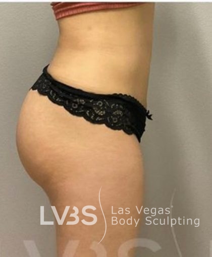 Liposuction Before & After Patient #787