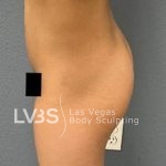 Liposuction Before & After Patient #787