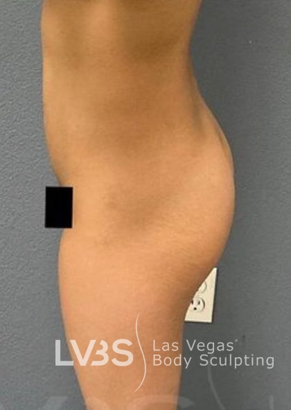 Liposuction Before & After Patient #787