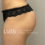 Liposuction Before & After Patient #787