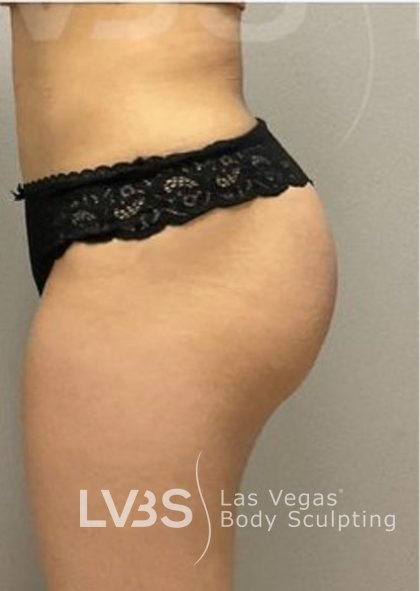 Liposuction Before & After Patient #787