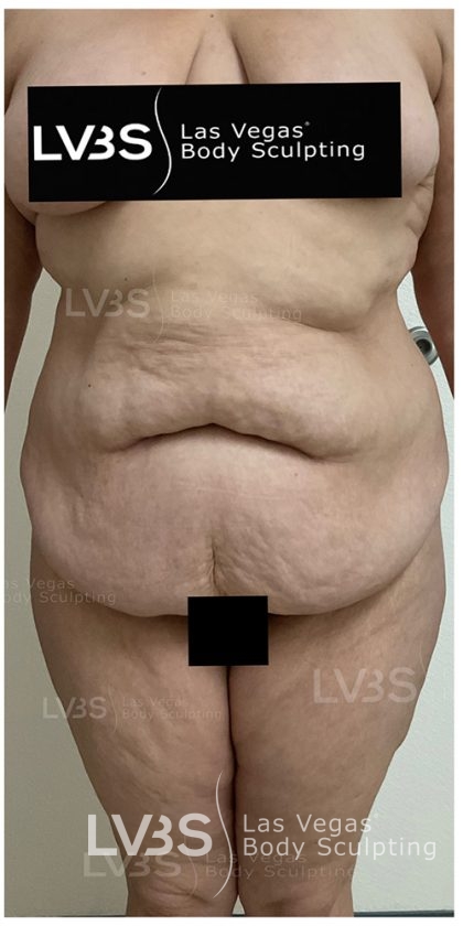 Liposuction Before & After Patient #812
