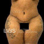 Liposuction Before & After Patient #809
