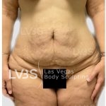 Tummy Tuck Before & After Patient #817