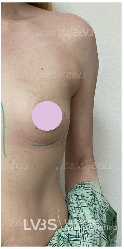 Breast Augmentation Before & After Patient #820