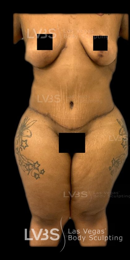 Liposuction Before & After Patient #809