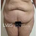 Brazilian Butt Lift (Fat Transfer to Butt) Before & After Patient #832