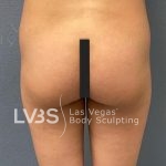 Brazilian Butt Lift (Fat Transfer to Butt) Before & After Patient #837