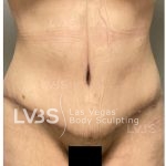 Liposuction Before & After Patient #812