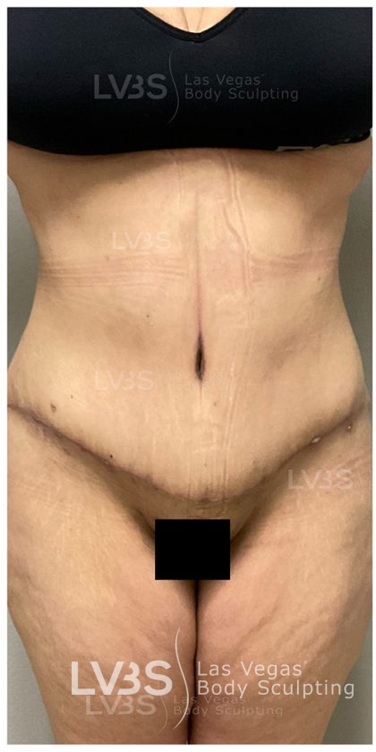 Liposuction Before & After Patient #812