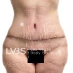 Tummy Tuck Before & After Patient #817