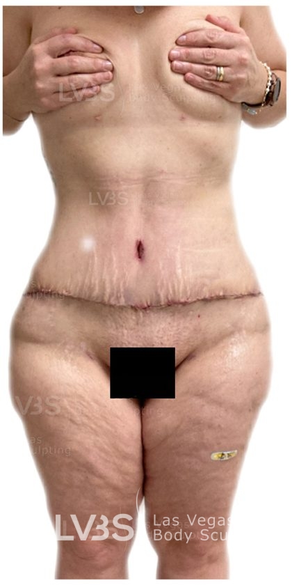 Tummy Tuck Before & After Patient #817