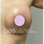 Breast Augmentation Before & After Patient #820