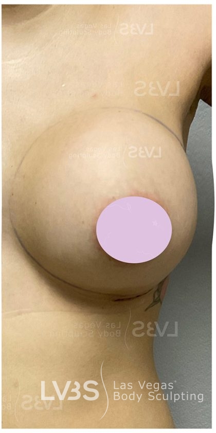 Breast Augmentation Before & After Patient #823