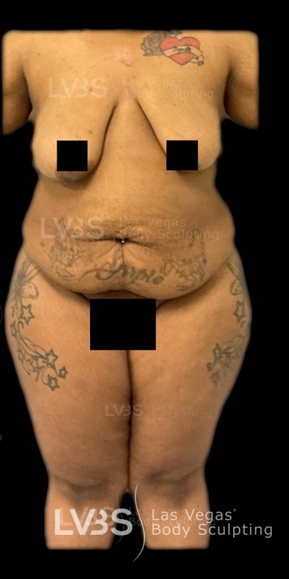 Liposuction Before & After Patient #809