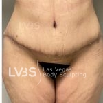 Brazilian Butt Lift (Fat Transfer to Butt) Before & After Patient #832