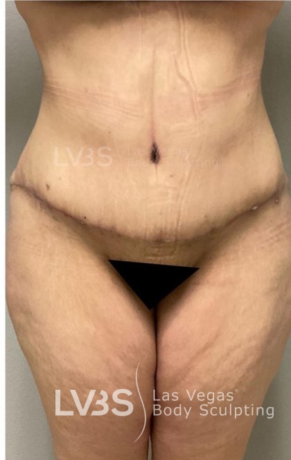 Brazilian Butt Lift (Fat Transfer to Butt) Before & After Patient #832