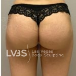 Brazilian Butt Lift (Fat Transfer to Butt) Before & After Patient #837