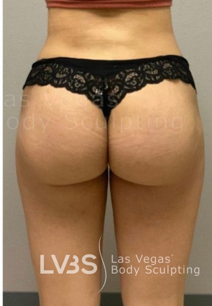 Brazilian Butt Lift (Fat Transfer to Butt) Before & After Patient #837
