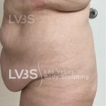 Brazilian Butt Lift (Fat Transfer to Butt) Before & After Patient #832