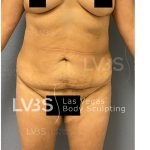 Liposuction Before & After Patient #812
