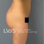 Brazilian Butt Lift (Fat Transfer to Butt) Before & After Patient #837