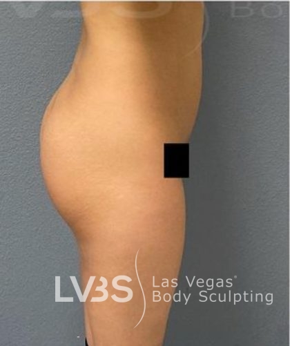 Brazilian Butt Lift (Fat Transfer to Butt) Before & After Patient #837