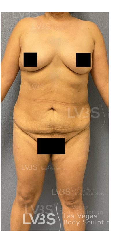 Liposuction Before & After Patient #812