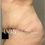 Brazilian Butt Lift (Fat Transfer to Butt) Before & After Patient #832