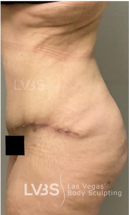 Brazilian Butt Lift (Fat Transfer to Butt) Before & After Patient #832