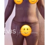 Liposuction Before & After Patient #812