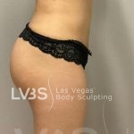 Brazilian Butt Lift (Fat Transfer to Butt) Before & After Patient #837